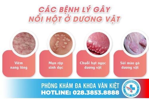 Hột lạ nổi trên bao quy đầu là dấu hiệu của nhiều bệnh lý nguy hiểm