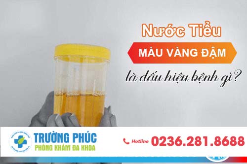 Nước tiểu màu vàng đậm là dấu hiệu bệnh gì?