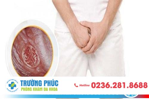 Những hình ảnh về tình trạng viêm da quy đầu ở nam giới