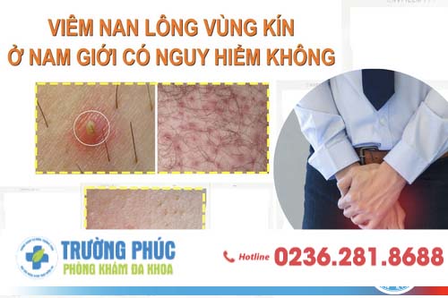 Viêm Nam Lông Ở Vùng Kín Nam Giới Có Nguy Hiểm Không?