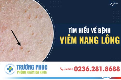 Bệnh Viêm Nang Lông Ở Nam Giới Là Gì? Dấu Hiệu Và Cách Phòng Ngừa