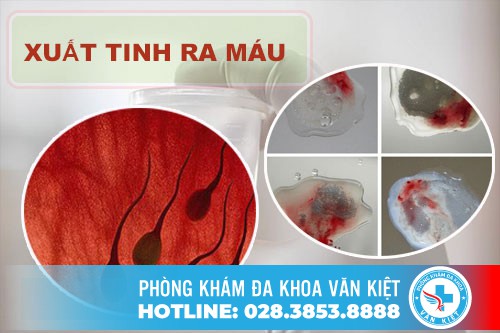 Xuất Tinh Ra Máu Có Nguy Hiểm Không?