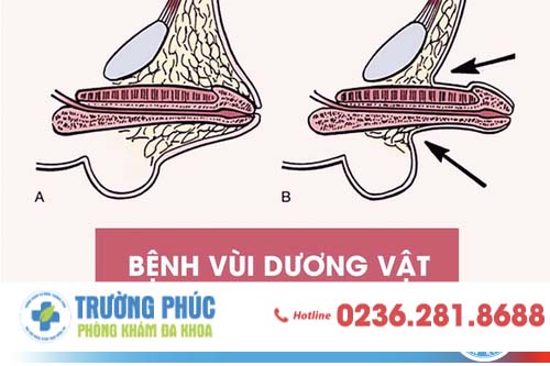 Vùi dương vật là gì và cách điều trị