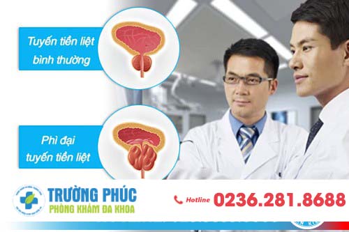 Bệnh phì đại tuyến tiền liệt là gì?