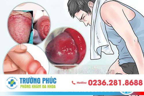 Đau bao quy đầu là dấu hiệu bệnh gì?