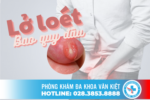 Lở loét bao quy đầu ở nam giới cảnh báo bệnh gì? Lở loét bao quy đầu ở nam giới cảnh báo bệnh gì?