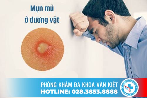 Dương vật nổi mụn, dấu hiệu của nhiều bệnh nguy hiểm khiến nam giới lo lắng