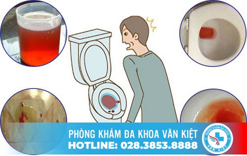 Nam Giới Đi Tiểu Ra Máu Có Thật Sự Nguy Hiểm ?