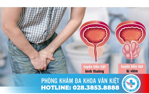 Nguyên Nhân Chính Gây Ra Bệnh Viêm Tuyến Tiền Liệt Ở Nam Giới