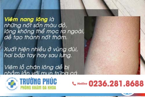 Nguyên Nhân Gây Viêm Nang Lông Vùng Kín Ở Nam Giới Là Gì?