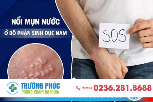 Dương vật nổi mụn nước - Dấu hiệu không nên xem thường