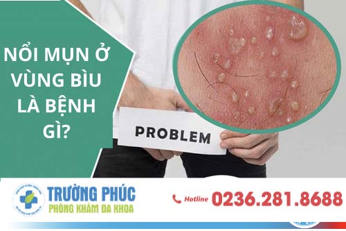 Nam giới nổi mụn mủ ở dương vật là bệnh gì?