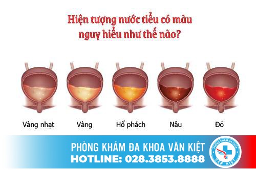 Hiện tượng nước tiểu có màu nguy hiểm như thế nào?