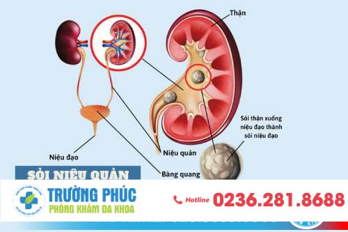 Phương pháp điều trị sỏi niệu quản hiệu quả