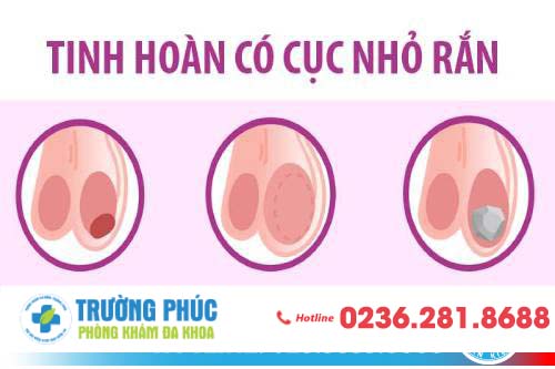 Tinh hoàn nổi cục cứng - dấu hiệu bệnh lý nguy hiểm