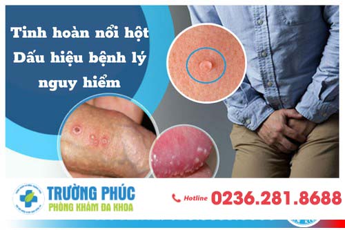 Tinh hoàn nổi hột - dấu hiệu bệnh lý nguy hiểm