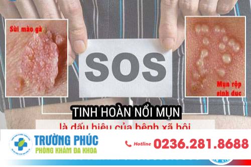 TINH HOÀN NỔI MỤN BẤT THƯỜNG NGUYÊN NHÂN DO ĐÂU?