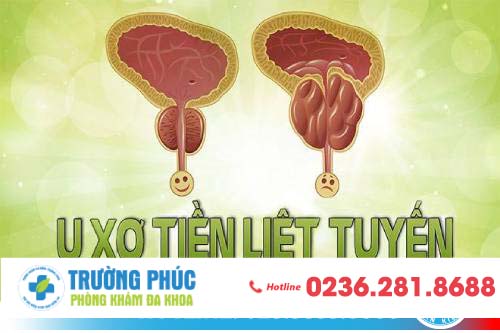 U Xơ Tuyến Tiền Liệt Là Gì?