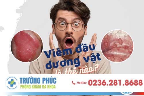 Nguyên nhân gây nên tình trạng viêm đầu dương vật là gì? Nguyên nhân gây nên tình trạng viêm đầu dương vật là gì?
