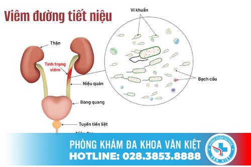 Dấu hiệu của viêm đường tiết niệu và cách điều trị