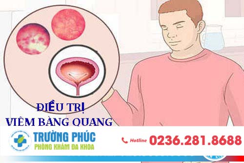 Điều trị viêm bàng quang như thế nào?